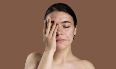 Фотоомоложение IPL: эффективное решение проблемы пигментации кожи